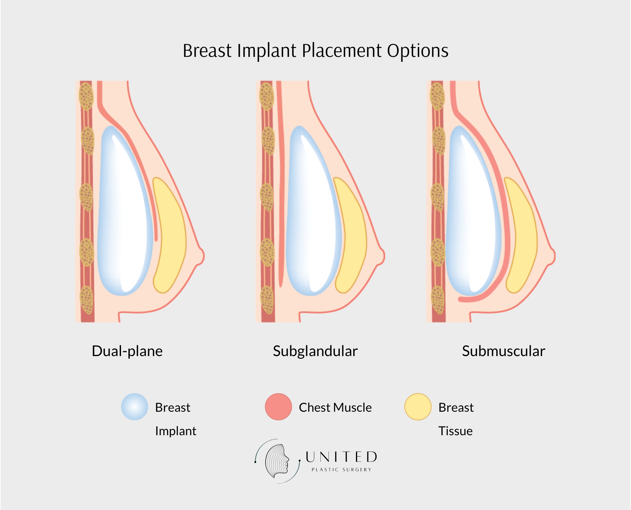 illustration showing three different options for breast implant placement