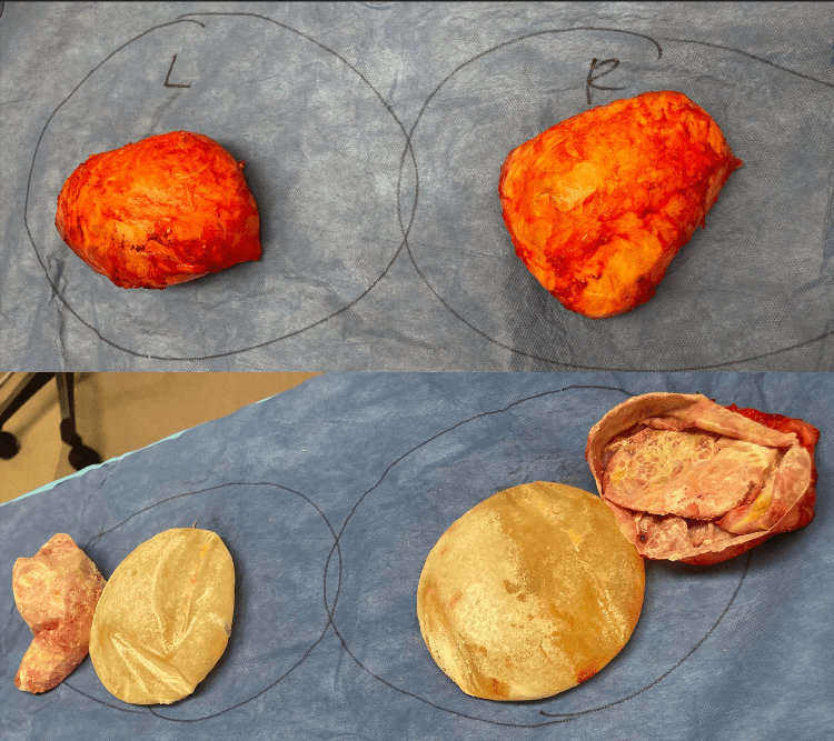 en bloc implant removal for capsular contracture and BII