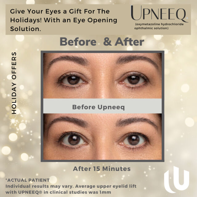 Give Your Eyes a Gift For The Holidays! Upneeq helps your eyes look bigger and brighter by lifting your eyelids, making you look and feel more awake.​​​​​​​​
​​​​​​​​
United Plastic Surgery Holiday Promotion:​​​​​​​​
Buy 1, Get 1 half off​​​​​​​​
5-day Supply for $50/ Second One for $25 ​​​​​​​​
10-day supply for $75/ Second One for $37.50 ​​​​​​​​
Buy a Box of 45 for $240/ Second One for $120​​​​​​​​
​​​​​​​​
Call us today and schedule an appointment with a free demo (951) 414-3530. Register to win a free pack of Upneeq!​​​​​​​​
​​​​​​​​
#UnitedPlasticSurgery #Temecula #upneeq